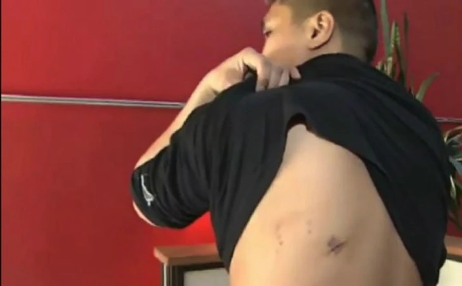 Ožiljak ga je svrbeo, ali su ga lekari ubeđivali da je to posledica oštećenja nerava