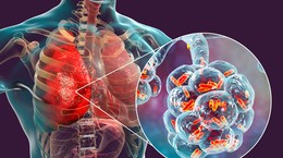 Zapalenie płuc to nie jest cięższe przeziębienie. Choroba jest śmiertelnie niebezpieczna