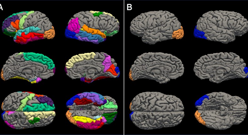 Female adolescent brains (left) experienced more cortical thinning than male brains (right), particularly in areas tied to socialization.Institute for Learning and Brain Sciences, University of Washington