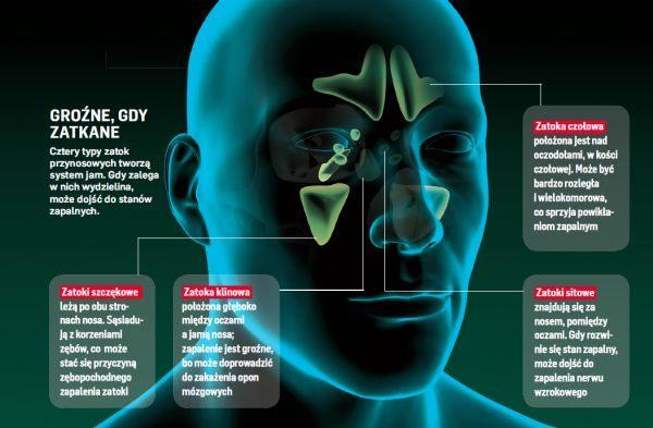 Jak Leczyć Zapalenie Zatok Metody Leczenia Zapalenia Zatok Newsweekpl 9349