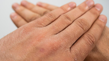 Zniszczone dłonie od dezynfekcji i problemy z cerą. Dermatolog radzi, jak pielęgnować skórę