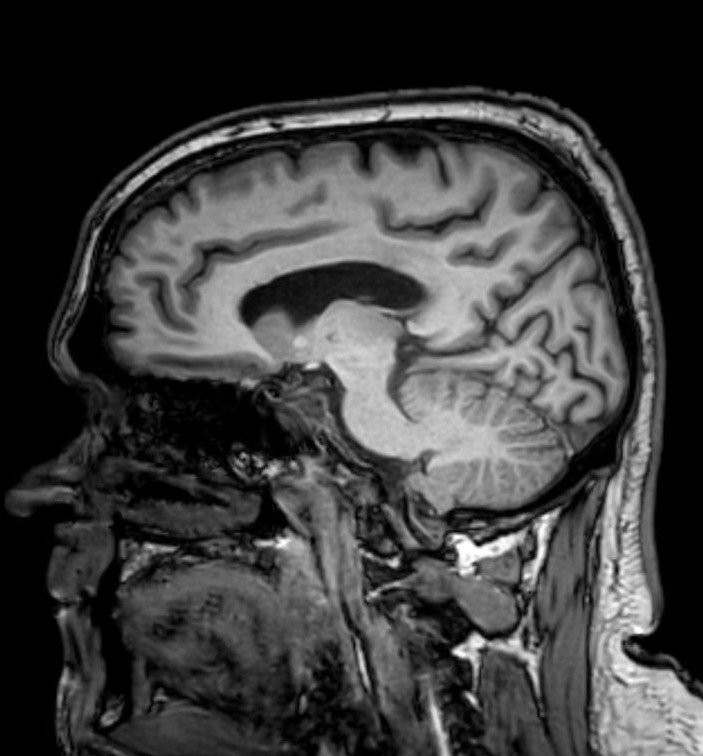 Jamie Brunt mal v čase nehody rakovinu.