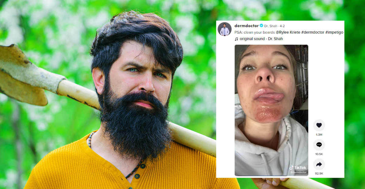 Całowanie się z brodatym mężczyzną, który nie dba o brodę, może doprowadzić do liszajca (fot. Faces Portrait/Shutterstock, tiktok.com/@dermdoctor)