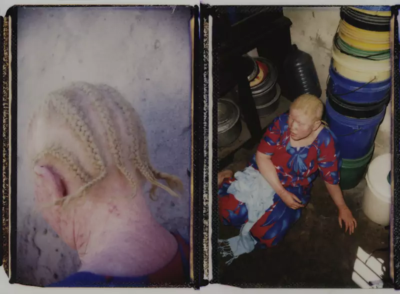Kiedy fala morderstw się rozpoczęła, Siwasahahu bała się o siebie i swoją rodzinę. Dziś, gdy liczba ataków spadła, musi mierzyć się z innymi ograniczeniami, które stoją przed osobami z albinizmem.