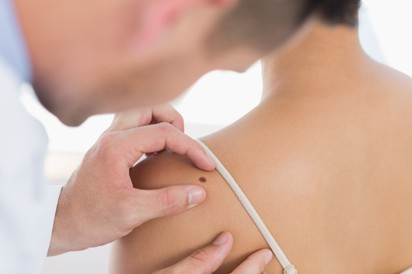 Melanóma ellen mRNS vakcina? Ez a terápia megakadályozhatja a kiújulást