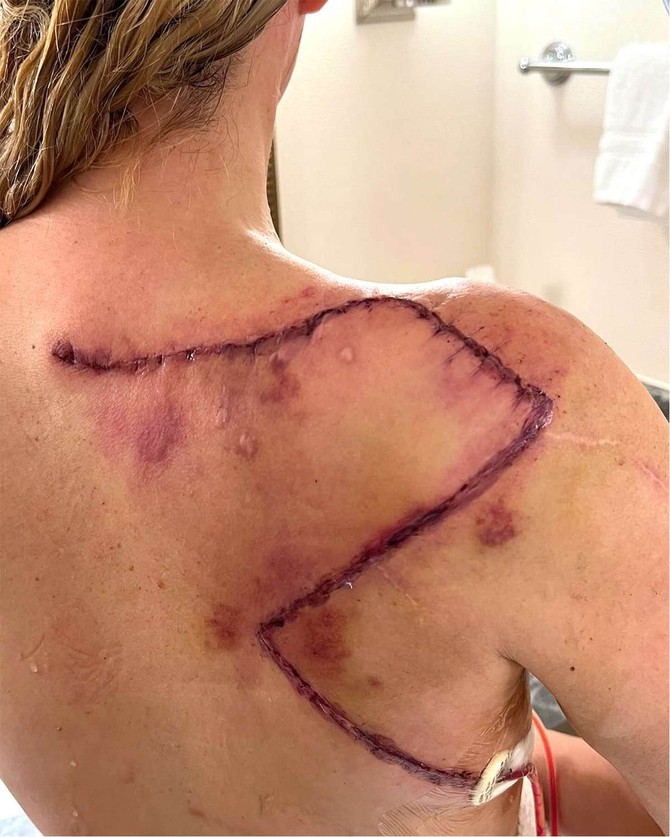 Ožiljci od mnogih operacija uklanjanja melanoma