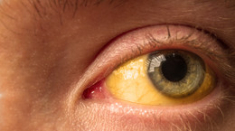 Czy żółte oczy to objaw choroby?