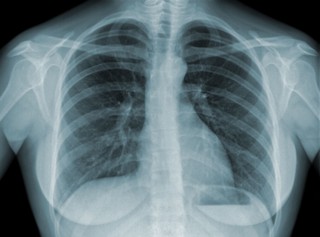 WHO: Po raz pierwszy od 10 lat roczny wzrost liczby zgonów na gruźlicę