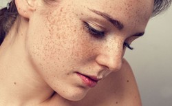 Jak pozbyć się przebarwień, plam na skórze?