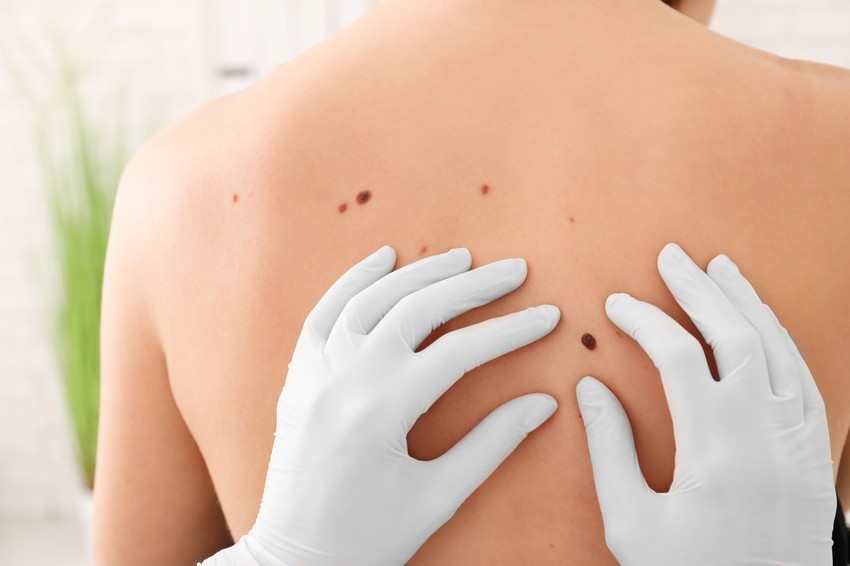 Kombinacija sunca i određenih lekova može da bude uzrok melanoma