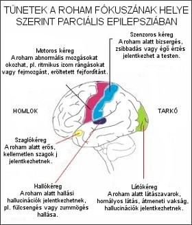 epilapszia280x327-d000006CB93745534b57d