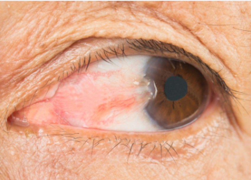 Pterigijum je prekomerni rast tkiva konjunktive