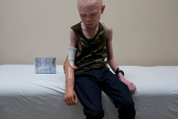 Baraka Lusambo, a Tanzanian with Albinism who had his arm chopped off in a superstition-driven attac