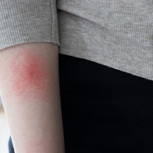 Évekkel később is gondot okozhat a kullancscsípés – ezek a Lyme-kór késői tünetei