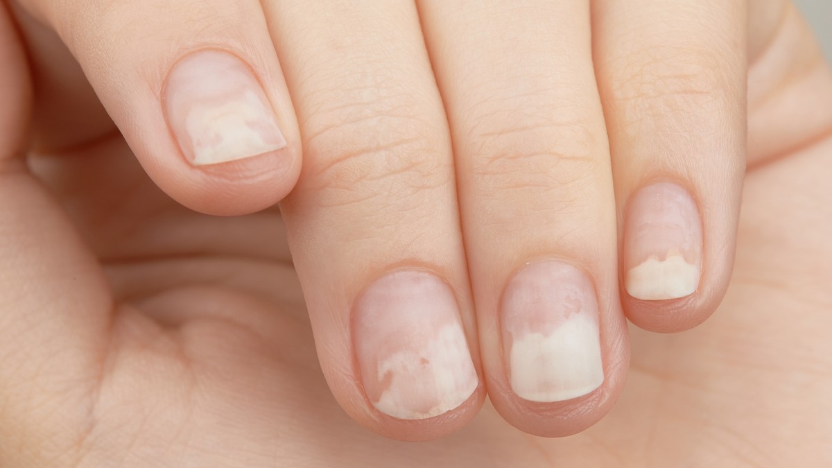 Oniholiza nastaje kada nokat i koža ispod njega nisu pričvršćeni