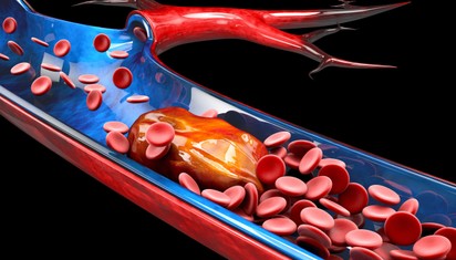 Így előzheti meg a szívelégtelenséget és a stroke-ot