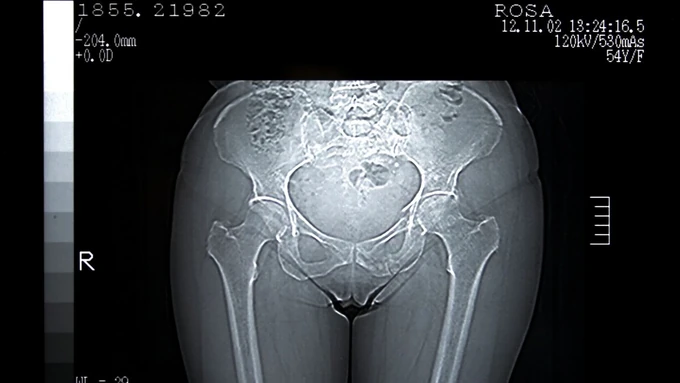 Devojka (22) došla na MAGNETNU REZONANCU, a čim su uključili uređaj počela je da VRIŠTI U AGONIJI: Lekari kad su videli šta je imala u ANALNOM OTVORU uhvatili se za glavu