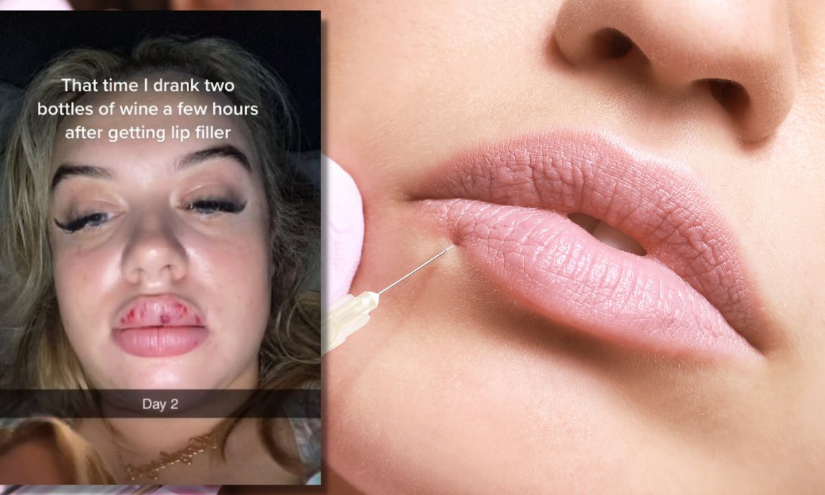 Wypiła alkohol po zabiegu powiększania ust. Pokazała, co się stało