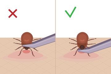 Hogyan kell kiszedni helyesen a kullancsot? Semmiképp se csavarja!
