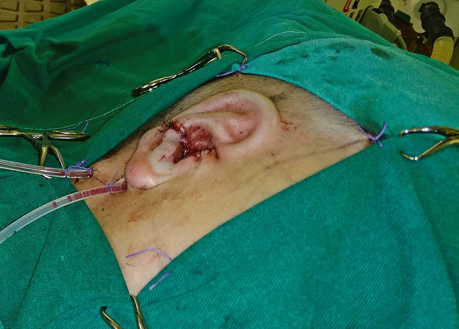 Rezultat hirurškog zahvata
