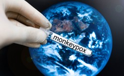 Małpia ospa. Jakie są objawy? Czy mamy się czego obawiać? Ekspert odpowiada