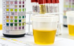 Badania moczu nie robi się ot tak! Jak przygotować mocz do analizy?