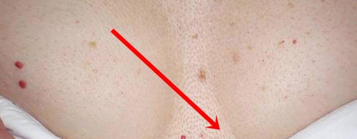 Bőrdaganatok: melyik a jó- és a rosszindulatú?, Vörös foltok anyajegyek formájában a bőrön