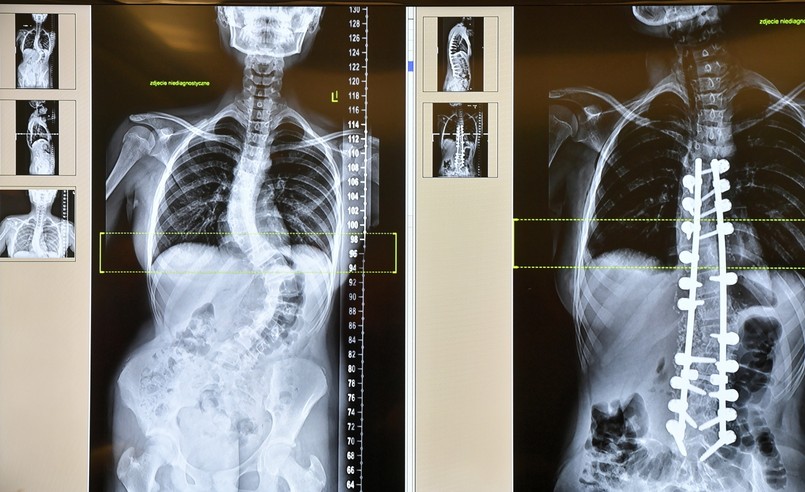 Zdjęcia RTG zaprezentowane podczas konferencji w szpitalu "Zdroje" w Szczecinie po operacji 13-letniej Natalii