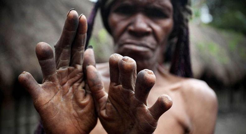 The finger-cutting as a mourning practice of the Dani People [Guardian]