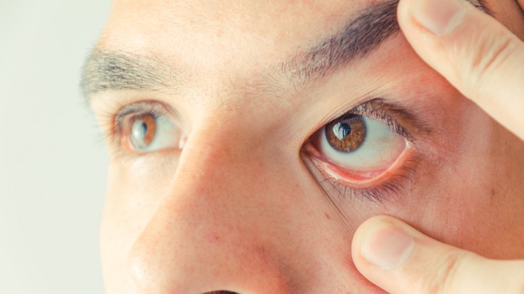 Retinoblastoma
