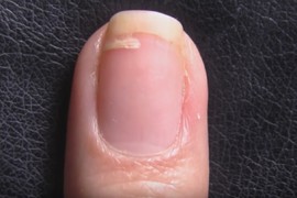 LINIJICA NA NOKTU žene (38) postala je RAK u terminalnoj fazi: Najpodmuklija bolest vraćala se 3 puta, sada strahuje da je KANCER prenela svojoj BEBI