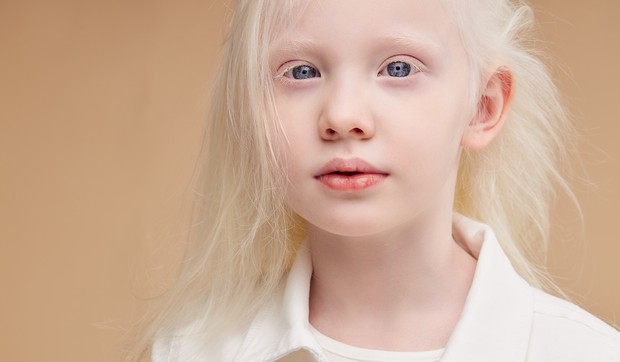 Najčešći oblik albinizma je okulo-kutani albinizam koji utiče na kožu, kosu i oči