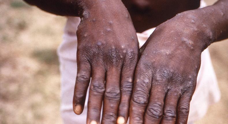 A person with monkeypox in the Democratic Republic of the Congo holds out their hands, which are covered in lesions.