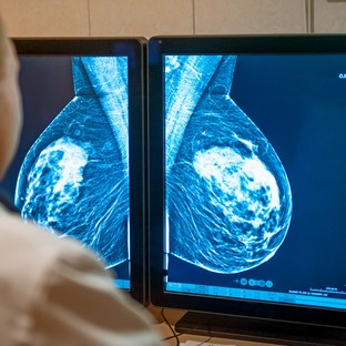 A mellrák korai felismerésére fejlesztenek új diagnosztikai eszközt szegedi kutatók