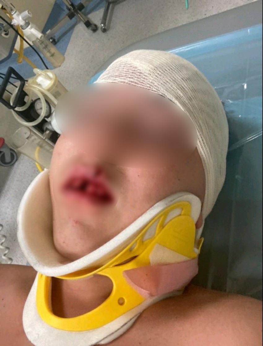 Povredjeni dečak pre ušivanja posekotina u Urgentnom centru u Nišu