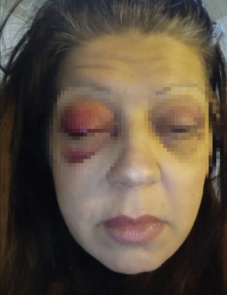 Beba Vasić pokazala povrede