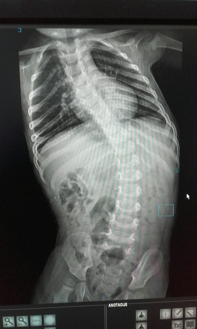 Kriva kičma devojčici može da pritiska druge organe, a majka strahuje kako će se ona razvijati kako bude rasla 