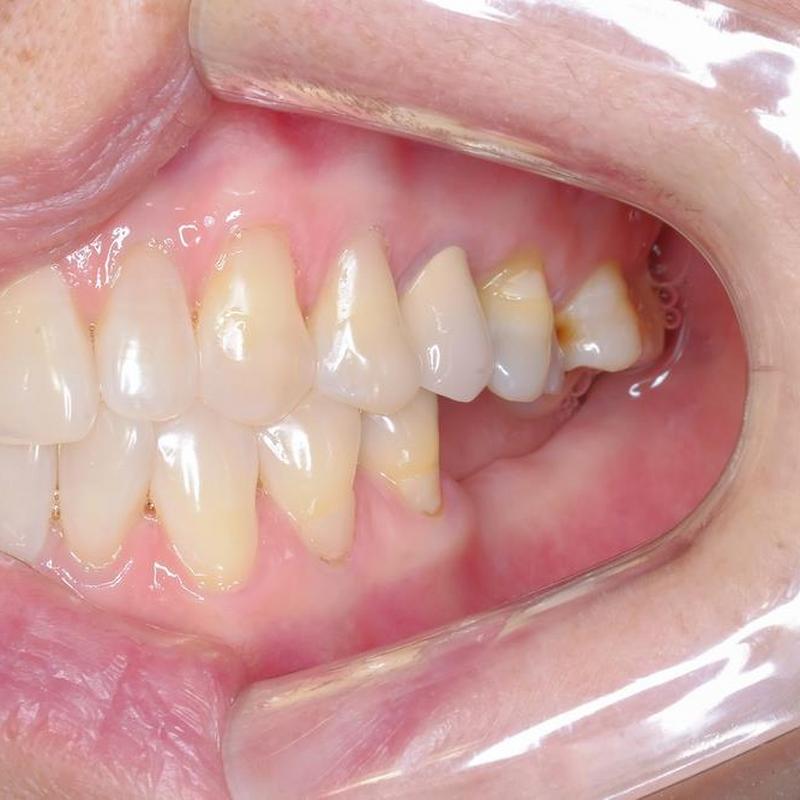 Co powoduje przebarwienia zębów?