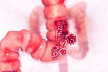 Vastagbélrák: ezek az ételek drámaian növelhetik a tumor kockázatát!