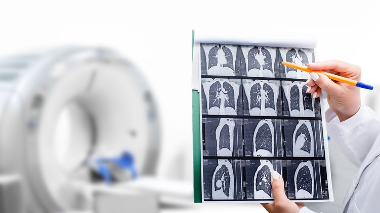nőnap tüdőrák szűrés Országos Korányi Pulmonológiai Intézet