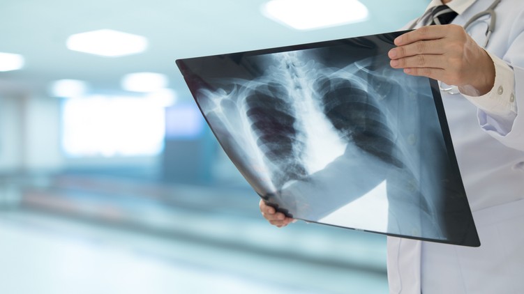 tüdőgyulladás veszélyes influenza szövődmény oltás