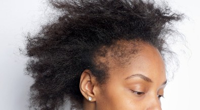 5 things that damage the hair and hairline of African women