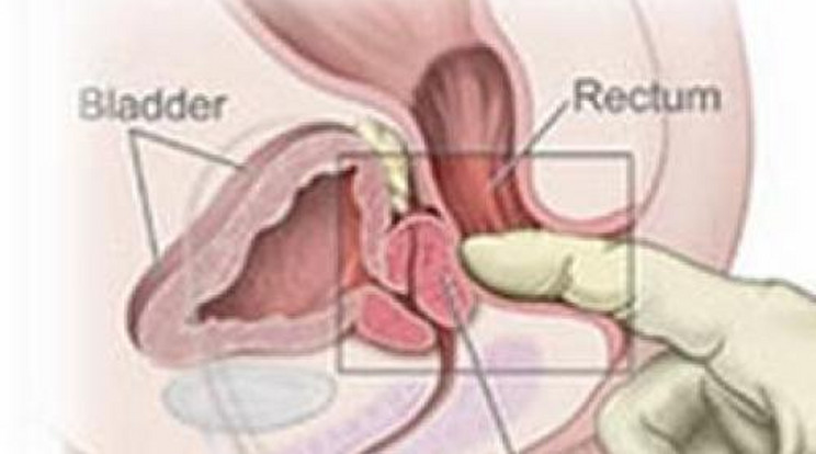 A prosztatamasszázs titkai