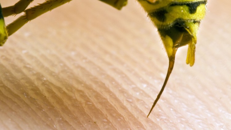 allergia darázscsípés után kalcium