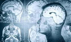 Implant w mózgu, który pozwoli odzyskać pamięć. Najnowsze odkrycie naukowców