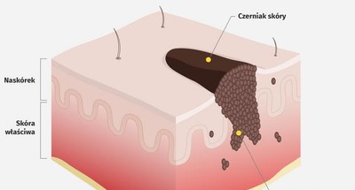Czerniak Skory Wszystko Co Musisz Wiedziec O Tym Nowotworze Infografika