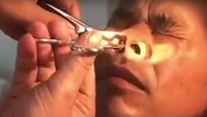 Gyomorforgató: piócát húzott ki az orvos egy férfi orrából – videó