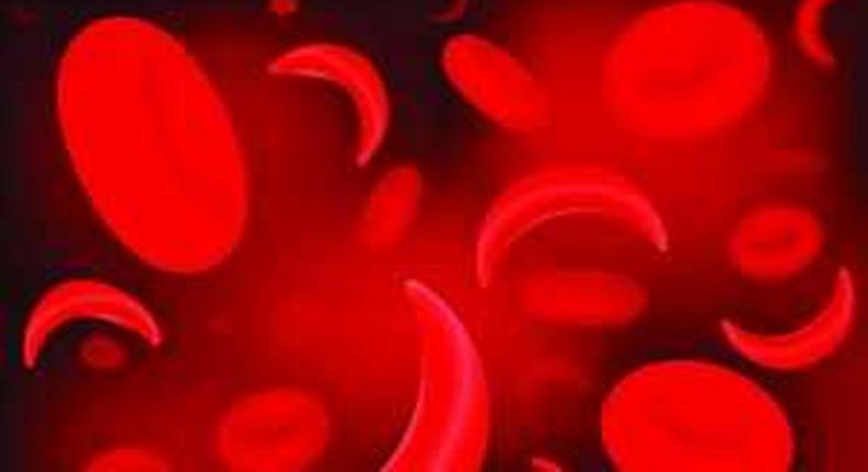 Red blood cells of sickle cell anaemia disease.