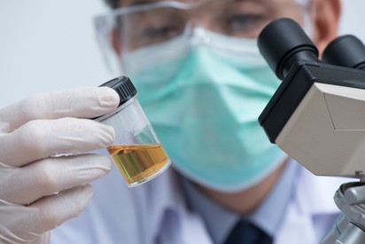 Vizeletvizsgálattal is ki lehet szűrni a méhnyakrákot okozó HPV-vírust