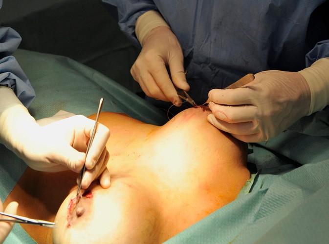 Według francuskiej agencji ds. produktów zdrowia Afssaps nie ustalono jednak żadnego związku między zachorowaniami na raka piersi a implantami PIP. Do Afssaps zgłoszono 1143 przypadki pęknięcia silikonowego implantu PIP oraz 495 przypadków stanów zapalnych spowodowanych przez silikonowy żel.